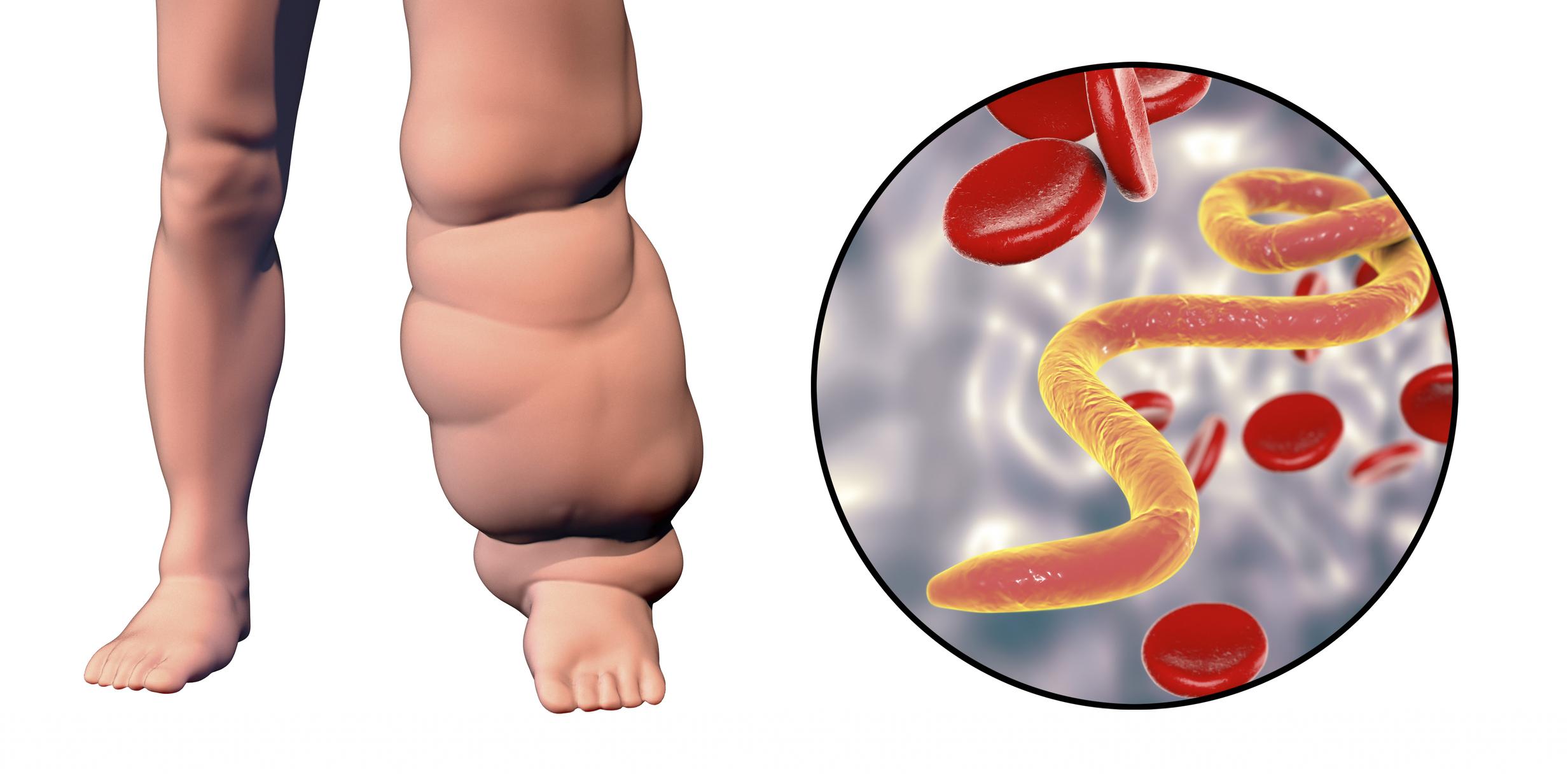 Qué es la elefantiasis causas síntomas y tratamiento Descubre cómo