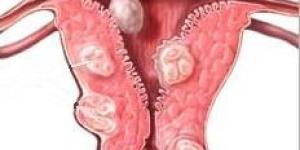 Cómo tratar los fibromas uterinos