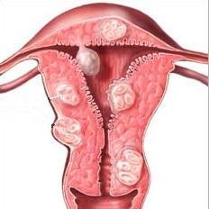 Cómo tratar los fibromas uterinos