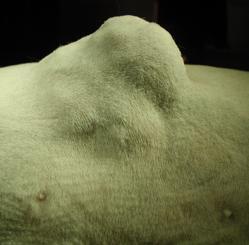 Cómo seguir un tratamiento de Fibrosarcoma