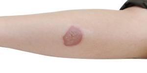 Cómo tratar las úlceras de la piel