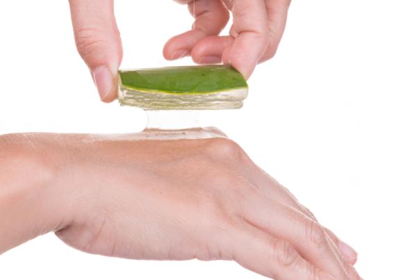 Remedios caseros para cicatrices queloides - Aloe vera