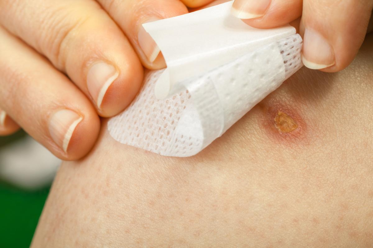 Remedios caseros para cicatrices queloides