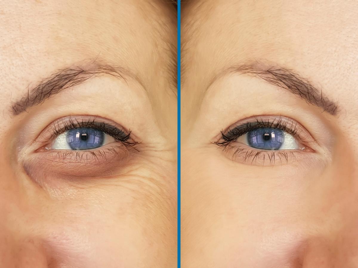 Cómo eliminar las ojeras hundidas