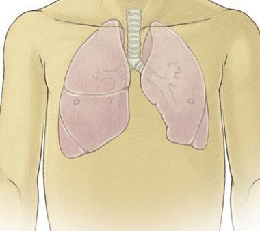 Cómo tratar el edema pulmonar