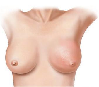 Cómo prevenir el linfedema en el cáncer de mama