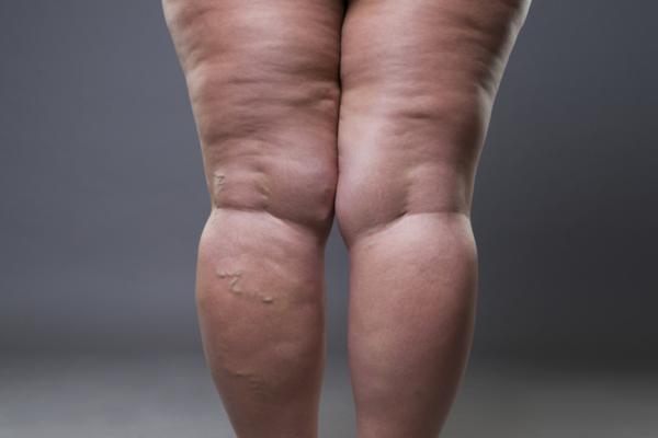 Lipedema: qué es y cómo prevenirlo - Qué es el lipedema y cómo se origina