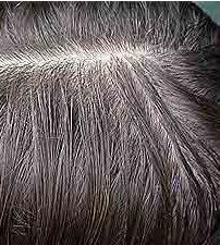 Cómo tratar la psoriasis del cuero cabelludo