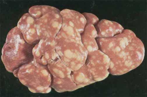 Cómo tratar la nefritis