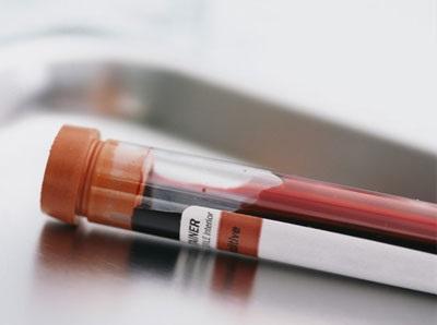 Qué es la anisocitosis