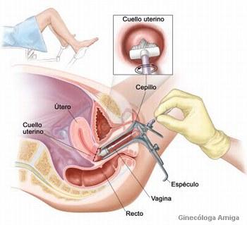 Cuáles son los síntomas del cáncer de cuello de útero - Paso 1