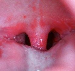 Cómo tratar la úvula inflamada