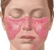 Cómo diagnosticar el Lupus Eritematoso Sistémico