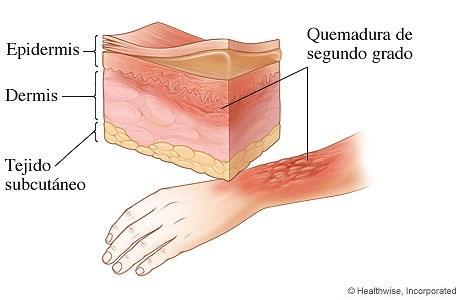 Cómo saber si una quemadura es de segundo grado