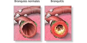Cuáles son los síntomas de la bronquitis