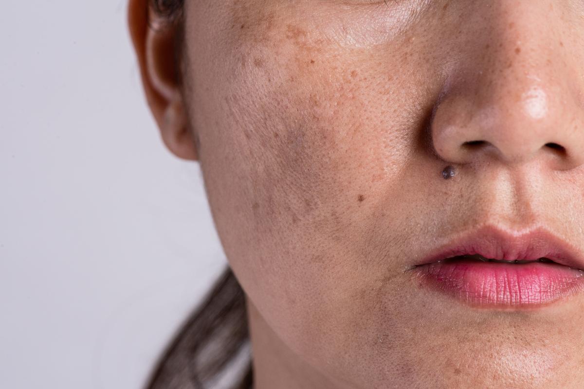 Melasma en el labio superior: por qué sale y tratamiento
