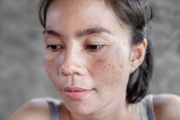 Melasma en el labio superior: por qué sale y tratamiento - Qué es el melasma en el labio superior y sintomatología