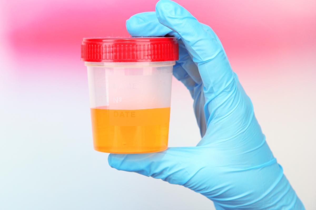 ¿Hay que guardar la muestra de orina en la nevera?