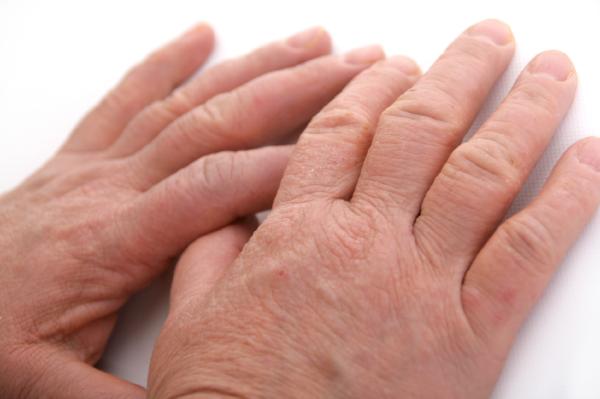 Por qué se me hinchan las manos