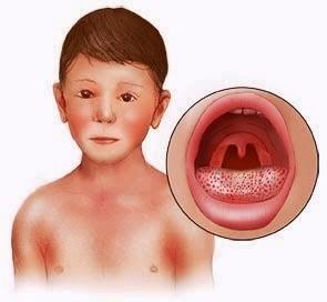 Cómo tratar la escarlatina