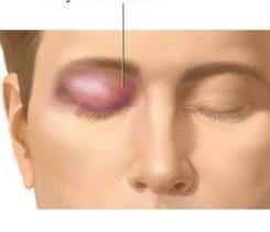 Cómo tratar una lesión en el ojo