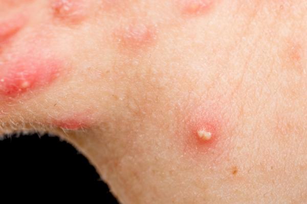 Por qué salen granos en el cuello