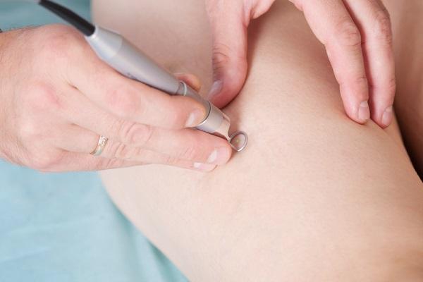 Cómo curar las varices en las piernas - Paso 2