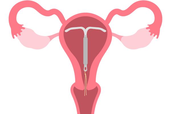 Cómo saber si estoy embarazada teniendo el DIU - Qué es el DIU y cómo funciona