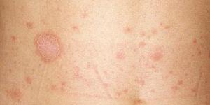 Cómo se manifiesta la pitiriasis rosada