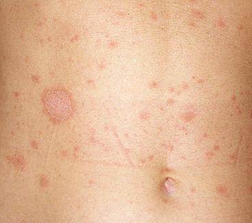 Cómo se manifiesta la pitiriasis rosada