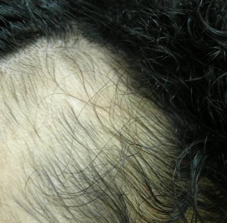 Cómo superar la tricotilomanía