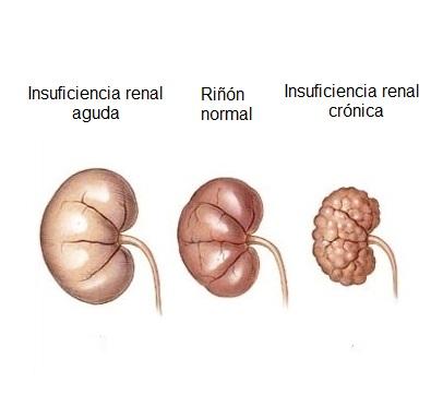 Cuáles son los síntomas de la insuficiencia renal - Paso 2