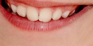 Cómo regenerar partes de un diente