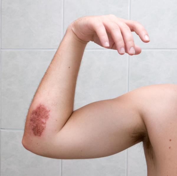 Cómo curar los golpes con remedios caseros