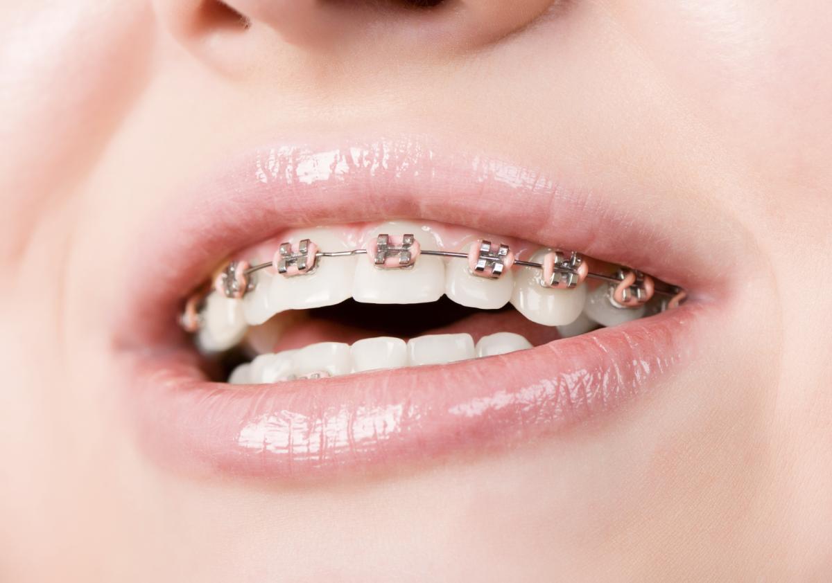Cómo evitar el mal aliento con brackets