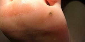 Cómo prevenir los papilomas de los pies
