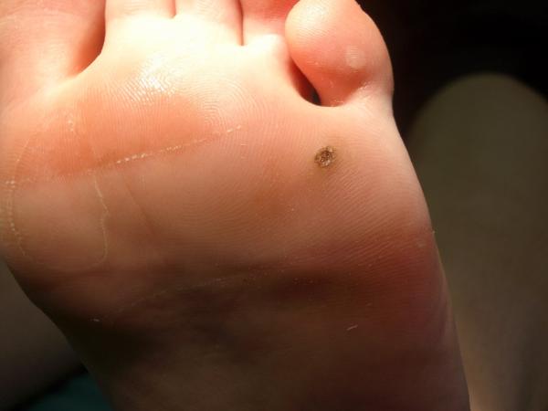 Cómo prevenir los papilomas de los pies