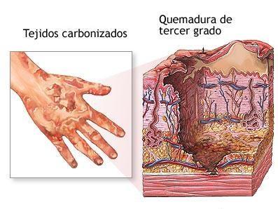 Cómo saber si una quemadura es de tercer grado