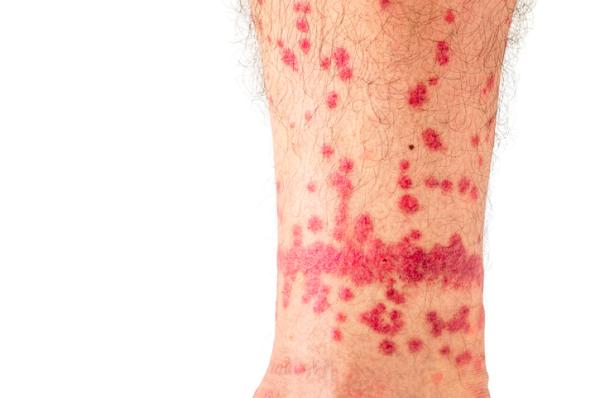 Cómo eliminar pulgas en humanos - Picaduras de pulgas: cómo eliminarlas