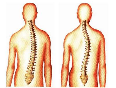 Cómo tratar la escoliosis