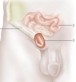 Cómo tratar una hernia
