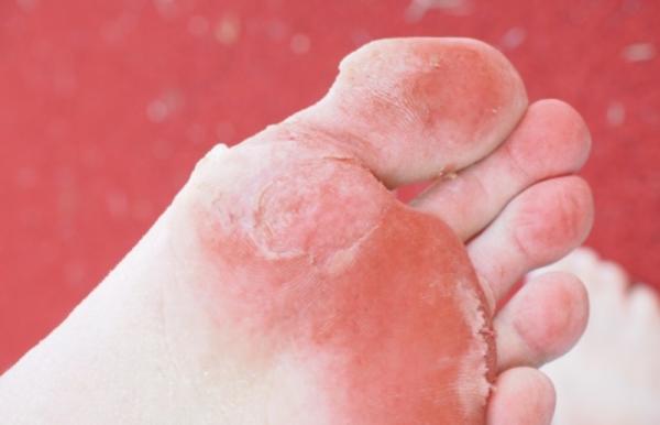 Cómo usar ácido bórico para los pies - Cómo usar ácido bórico para los hongos en los pies - paso a paso