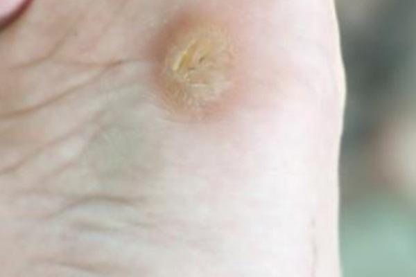 Cómo quitar los ojos de pescado en las manos