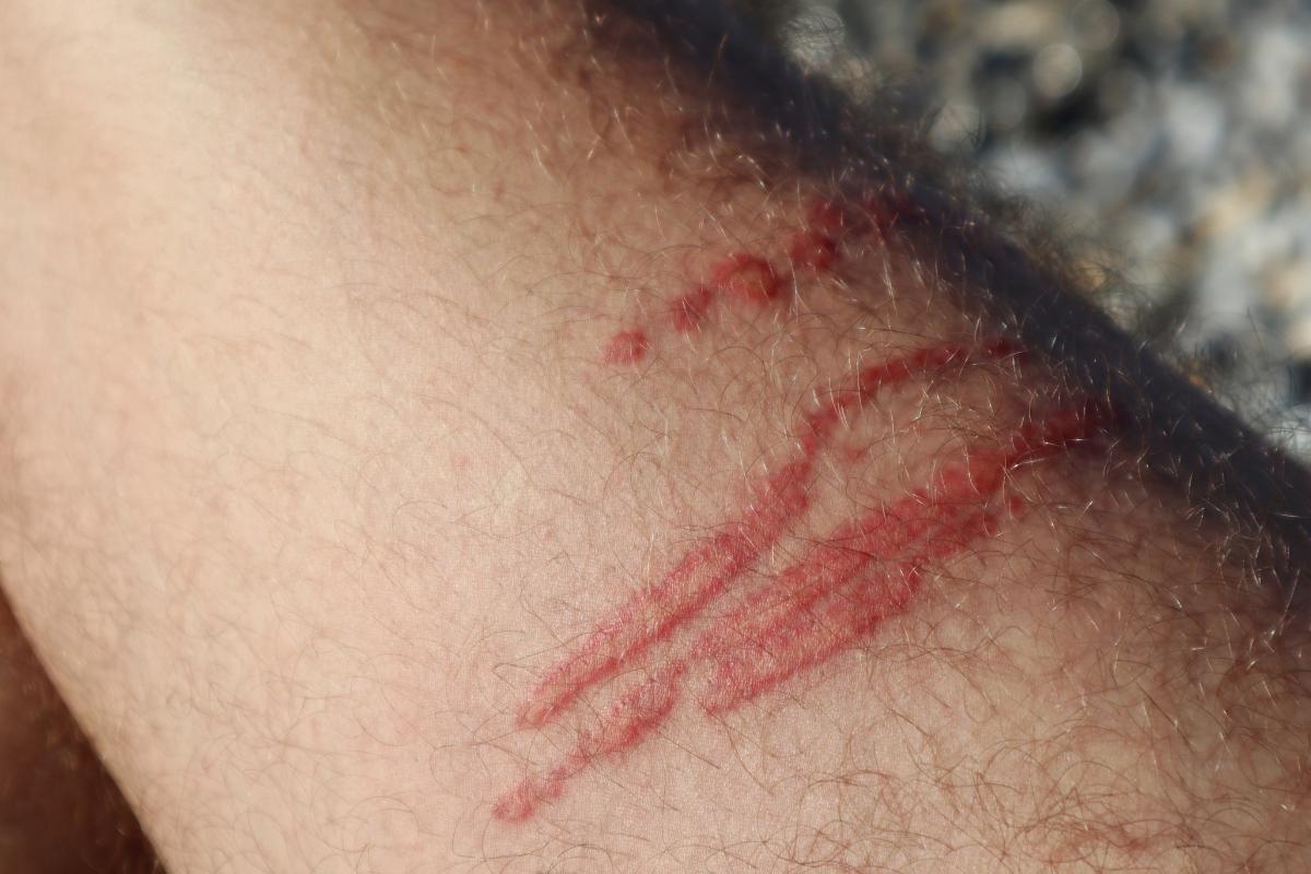 Picadura de anémona: síntomas y tratamiento para la rozadura con este animal marino