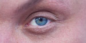 Por qué salen bolsas en los ojos y cómo prevenirlas
