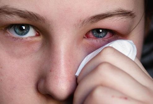 Cómo evitar el contagio de la conjuntivitis