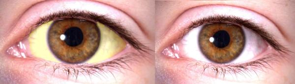 Síntomas que indican problemas en el hígado - Color amarillento en ojos y piel y comezón 