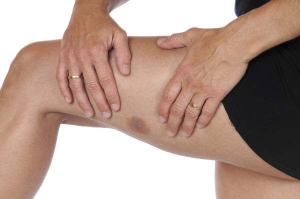 Síntomas que indican problemas en el hígado - Hematomas en la piel 