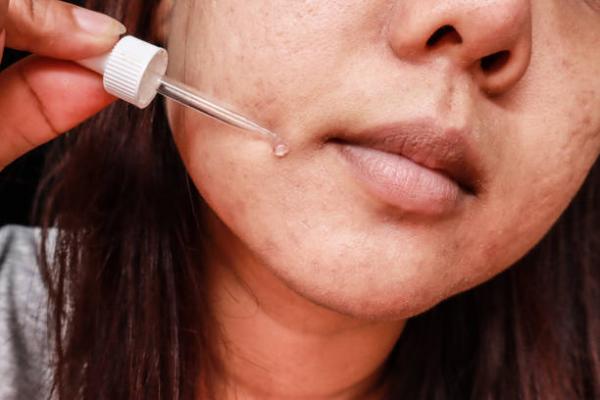 Cómo quitar lo negro del bigote