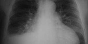 Cómo son las complicaciones de la toracocentesis